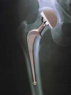 omaha total hip replacement