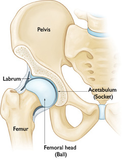 Revision Total Hip Replacement - OrthoInfo - AAOS